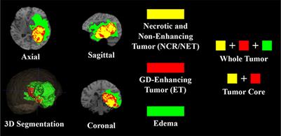 Novel Volumetric Sub-region Segmentation in Brain Tumors